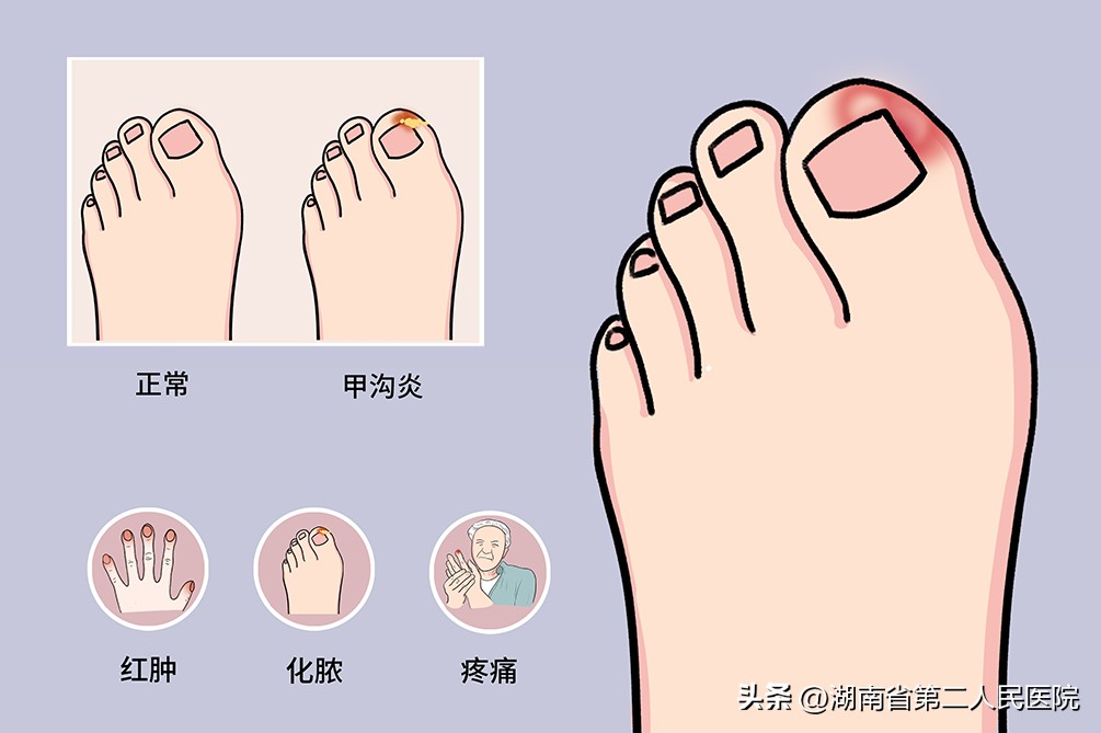 甲沟炎脚气脚臭脚痒的克星,如何消除甲沟炎引起的脚臭