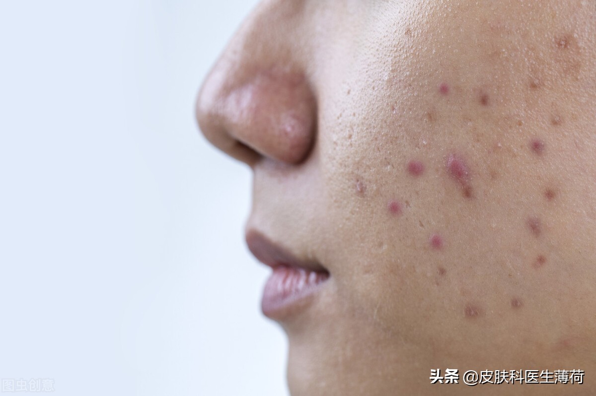 白天抗痘消炎夜晚淡化痘印,长痘就留痘印怎么去掉小妙招