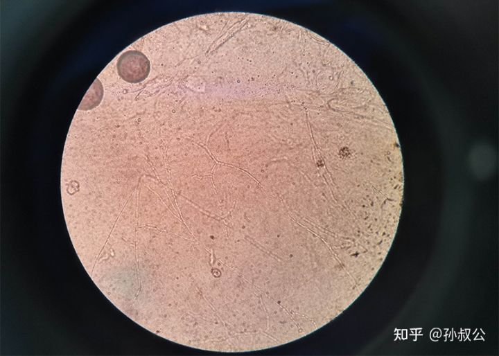 小孩得灰指甲怎么办,灰指甲往肉里长怎么办