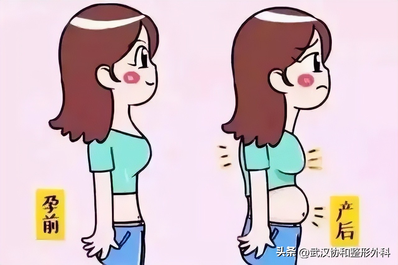 腹壁整形需要咨询问题,腹壁整形术亲身经历分享