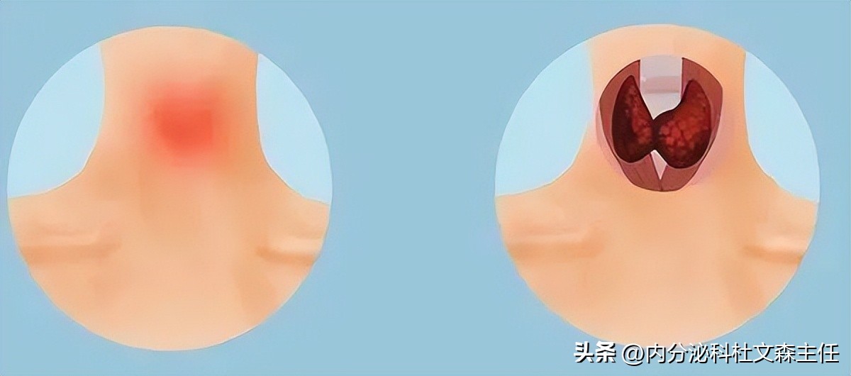 结节囊肿息肉，健脾祛湿不管用？往往是阳虚了，送你一方除根！