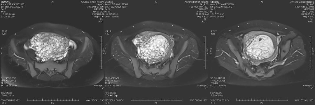 这么典型的葡萄胎MRI影像，快来学习吧