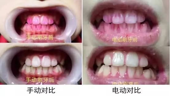 电动牙刷的伤牙危害要小心,使用电动牙刷对牙齿有什么危害