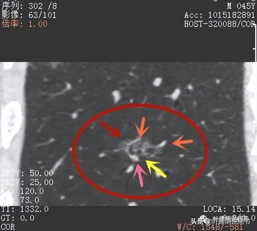 肺蜂窝状改变是肺癌吗,肺部陈旧灶与肿瘤怎么确诊