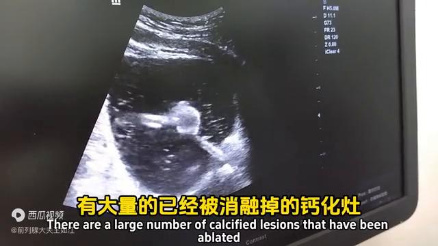 孔院长解读：什么是尿道疏通扩张术？配合前列腺钙化消融术...