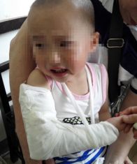 肱骨骨折取钢板怎样恢复,肱骨近端骨折切开复位内固定术