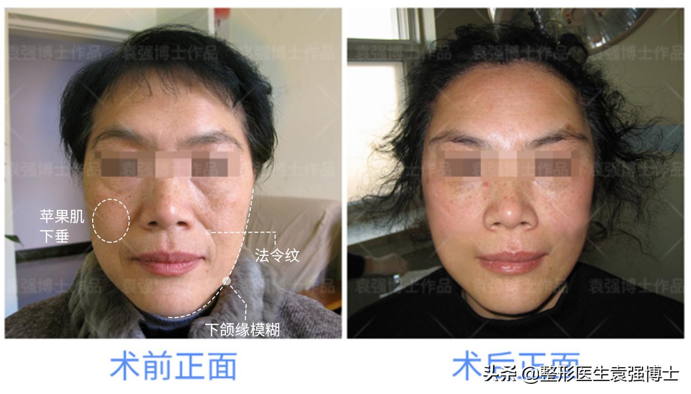 小切口面部提升能维持多久,面部提升的穴位手法完整视频