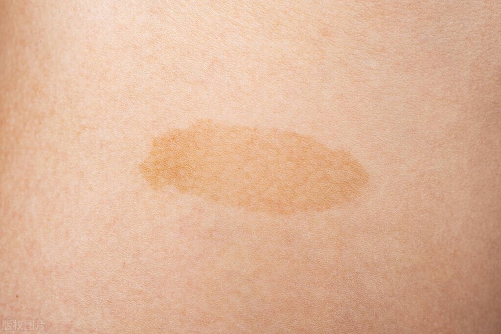 什么样的老年斑会发生癌变,肚子长老年斑是癌症状吗