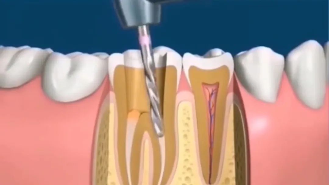 根管治疗为什么反复拍牙片,根管治疗期间为什么要拍牙片