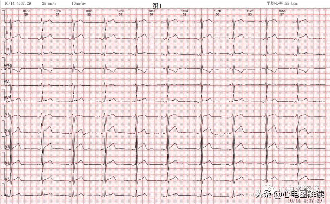 窦性心律部分见窦房游走性心律,窦性心律不齐游走性心律