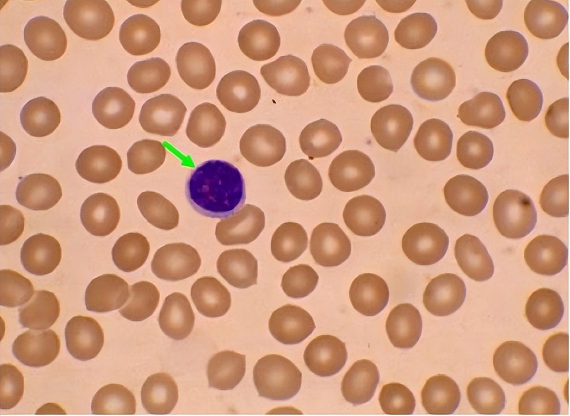 分泌性中耳炎是什么，为什么儿童得病几率更大，要怎么治疗