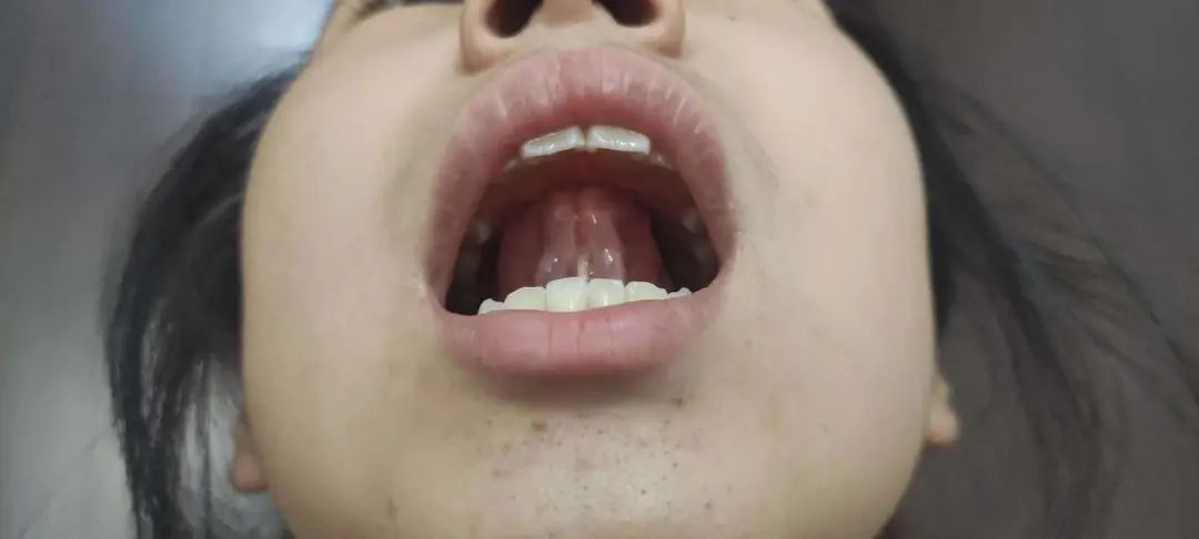 孩子嘴巴张不开发音小,小孩声带发育异常导致说话不清楚