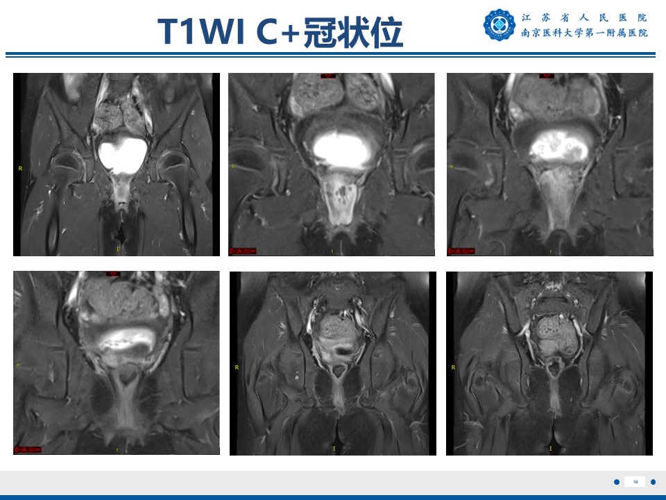 好文分享——《胚胎型横纹肌肉瘤》