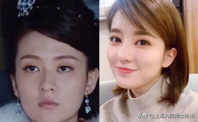 一般做个眼综合双眼皮多少钱,双眼皮和眼综合的区别图片