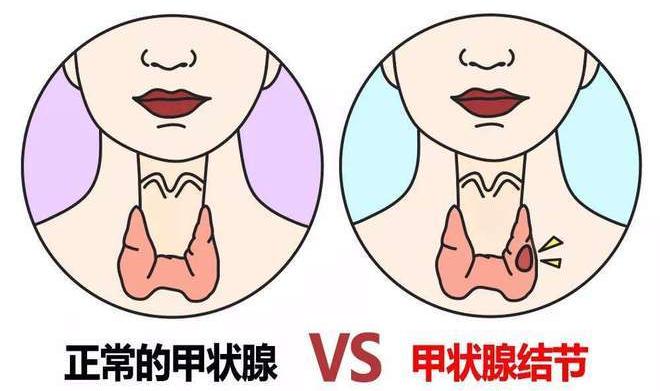 张景明甲状腺结节治疗方子,中医治疗甲状腺结节的中药方子