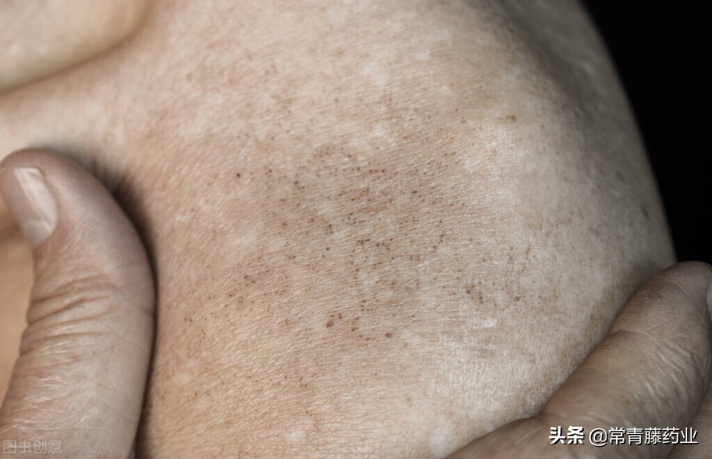 你有皮肤黑粗暗黄的烦恼吗,你有斑的烦恼吗