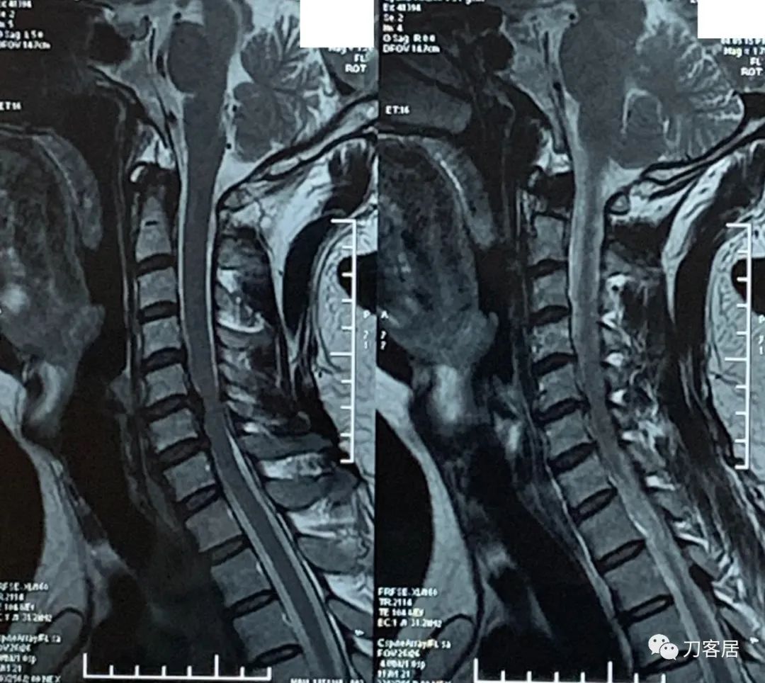 左上肢麻木的病历,颈椎病颈肩胳膊发麻用手术么