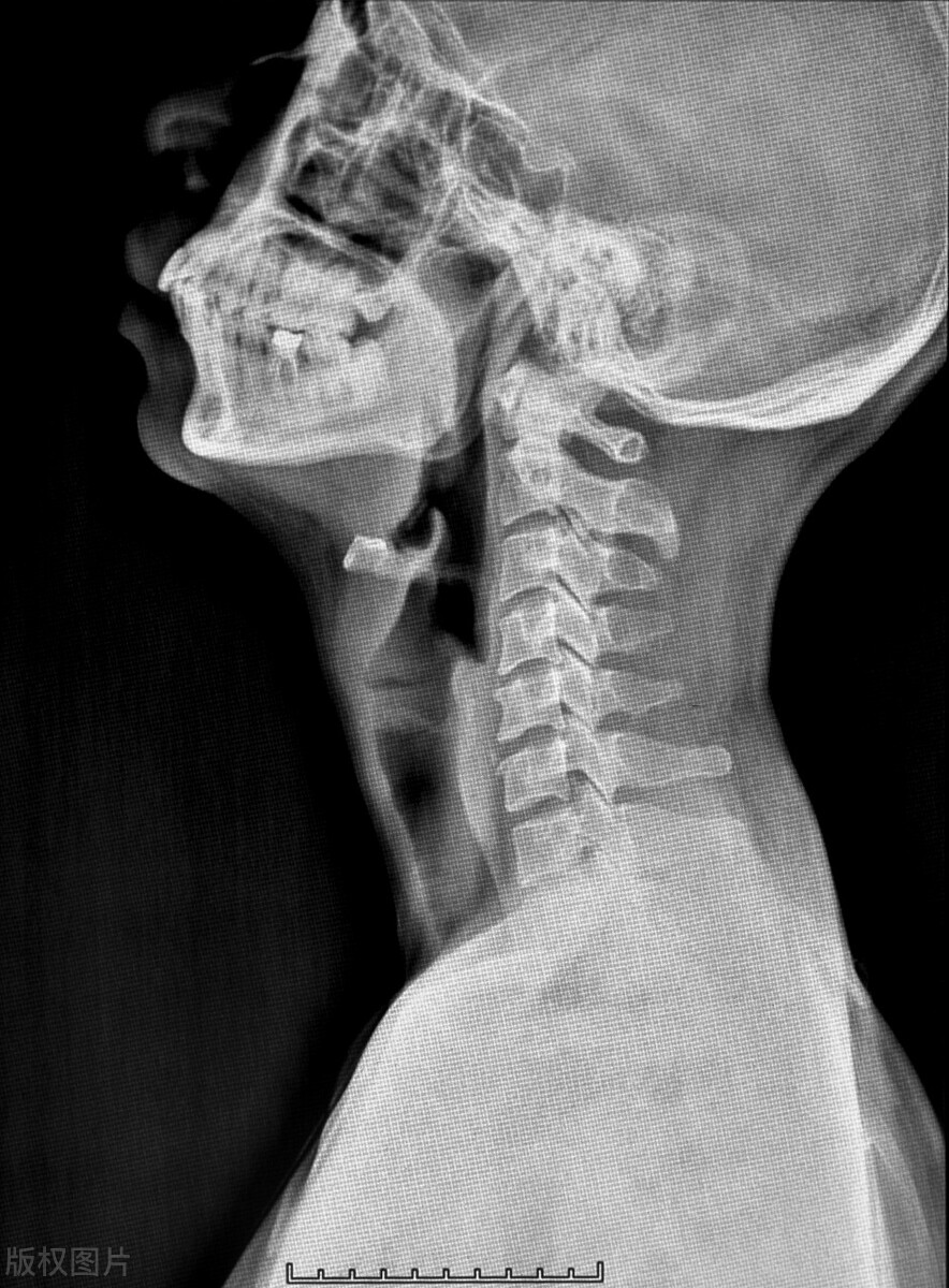 中医治疗颈椎病的十大妙招,中医治疗颈椎病效果怎样