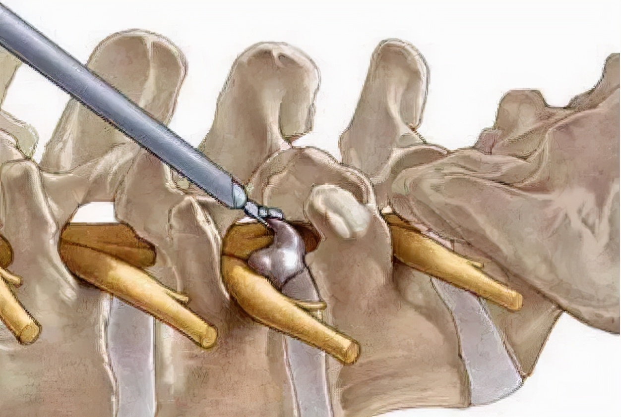 椎间孔镜微创手术全过程,椎间孔镜正面微创手术全过程
