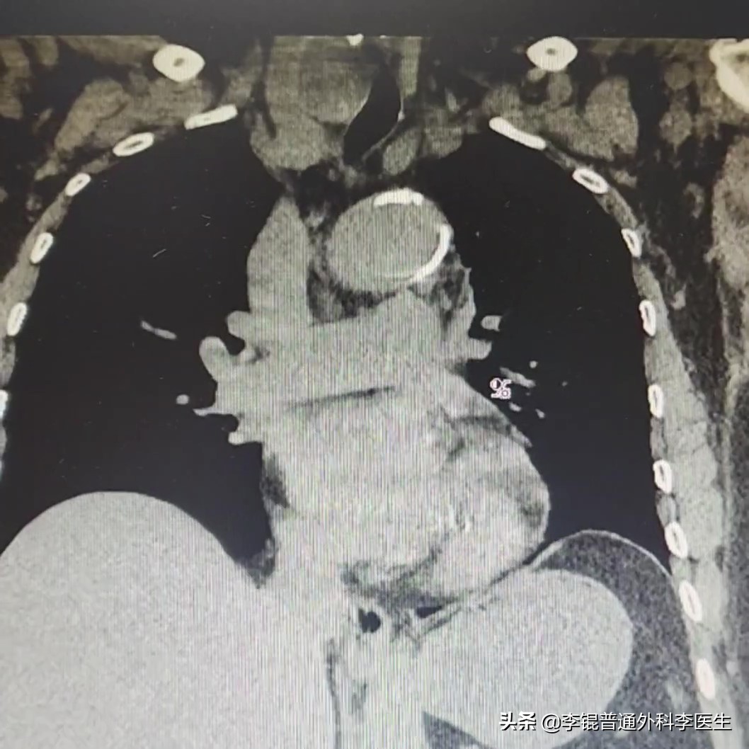 老人肺炎一整个肺都不好使怎么办,老人肺炎反反复复能治好吗