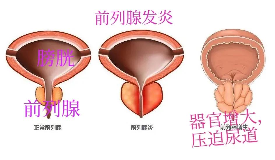 急性前列腺炎怎么治疗效果好得快,急性前列腺炎症状及处理方法