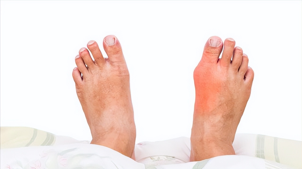 陈医生讲痛风,程凯养生说痛风急性发作时咋处理