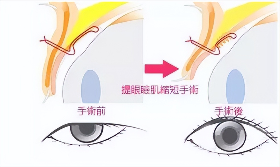 双眼皮显凶的面相,眼睛显凶相