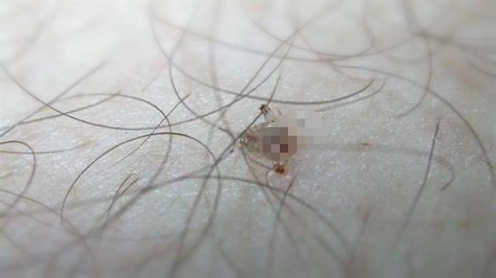 孩子眼睛长阴虱怎么处理,阴虱长在小孩眼睫毛上