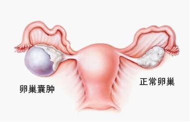 子宫肌瘤的中医治疗方法有哪些,中医治疗子宫肌瘤最好的治疗方法