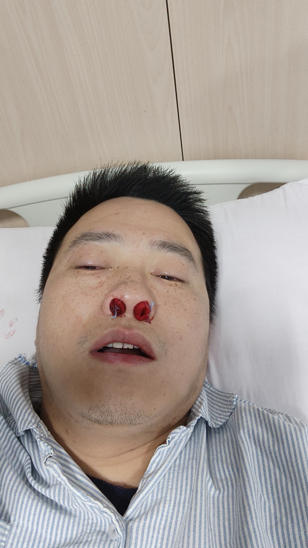 给鼻窦炎打了个措手不及------记与鼻窦炎的抗争二