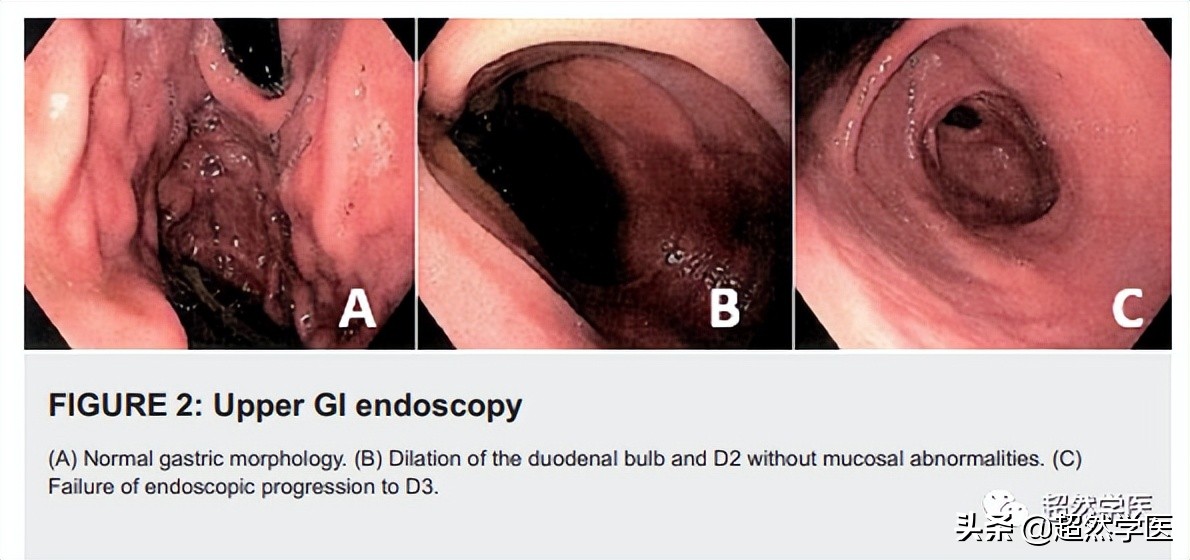 十二指肠球部狭窄导致呕吐,十二指肠降部隆起梗阻呕吐