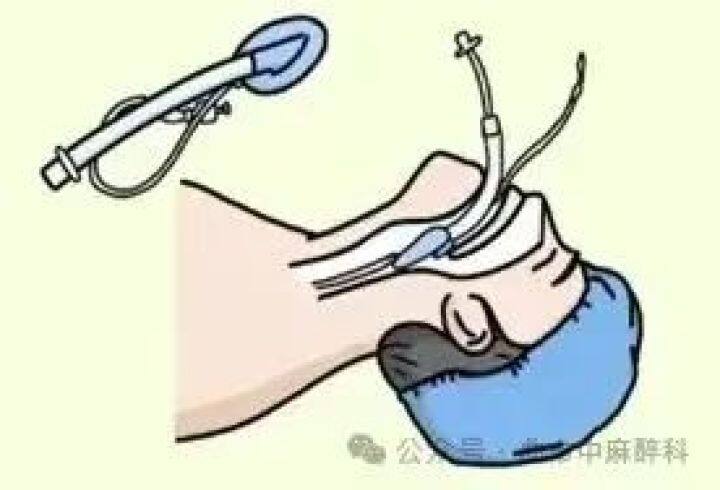 曲靖市中医医院成功开展Tubeless新技术，为患者康复加速助力