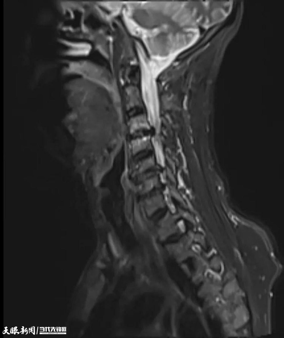 遵义市中医院医生全力救治,“瘫痪”患者“重获新生”