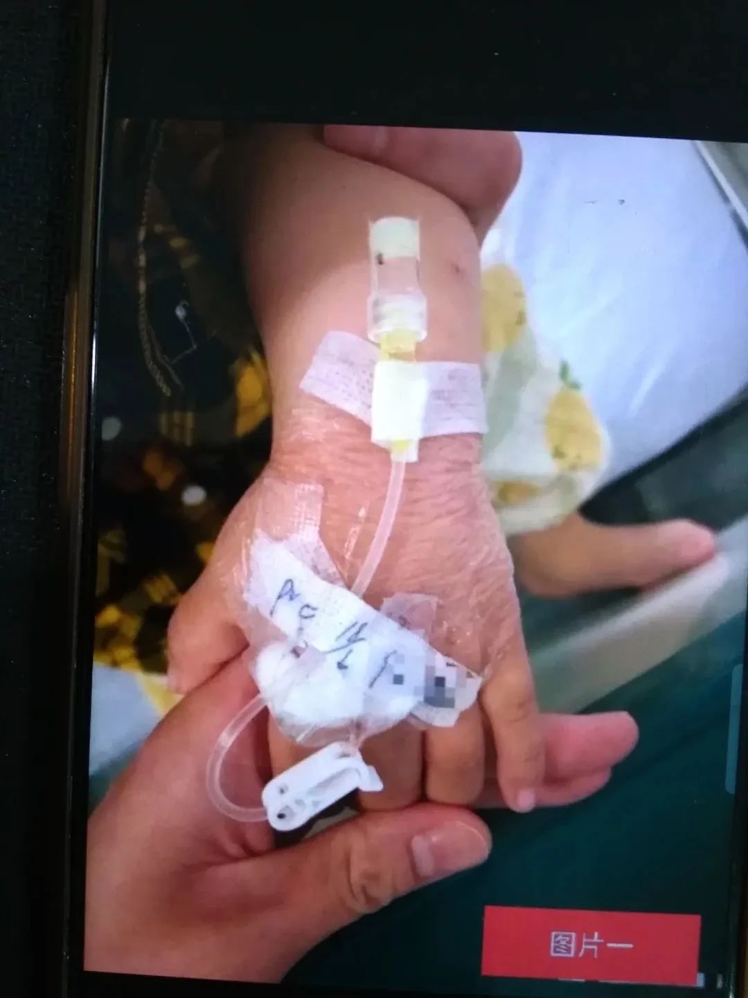 婴幼儿留置针固定最好的方法,如何能快速固定新生儿留置针