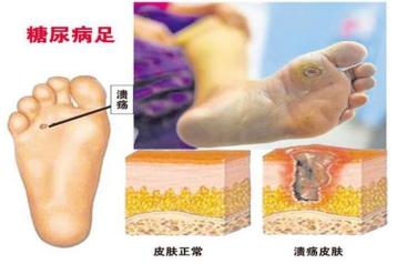 【健康遵义】糖尿病足，伤不起的狠“脚”色！怎么预防？