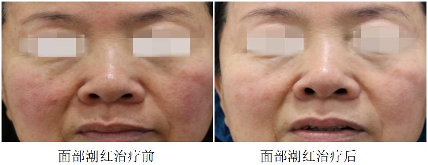 光子嫩肤济南市中心医院,济南光子嫩肤哪家医院最好