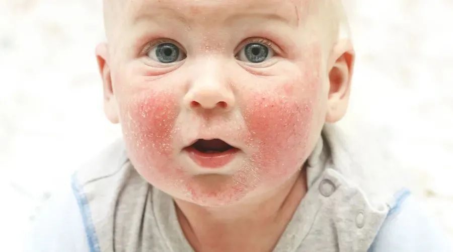 儿童生疹子哪里红点多,怎么区分孩子起的各种疹子