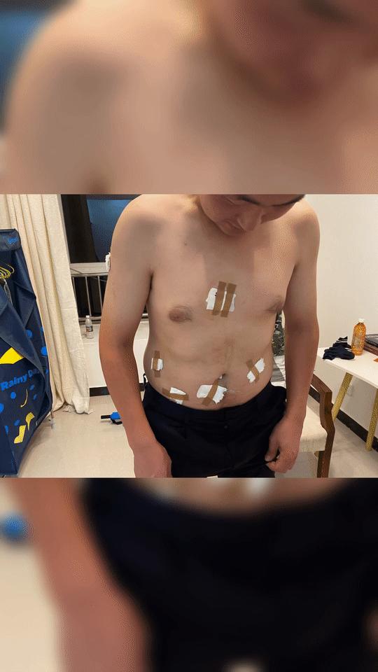 心疼！他从身上，清理出35条蚂蝗……