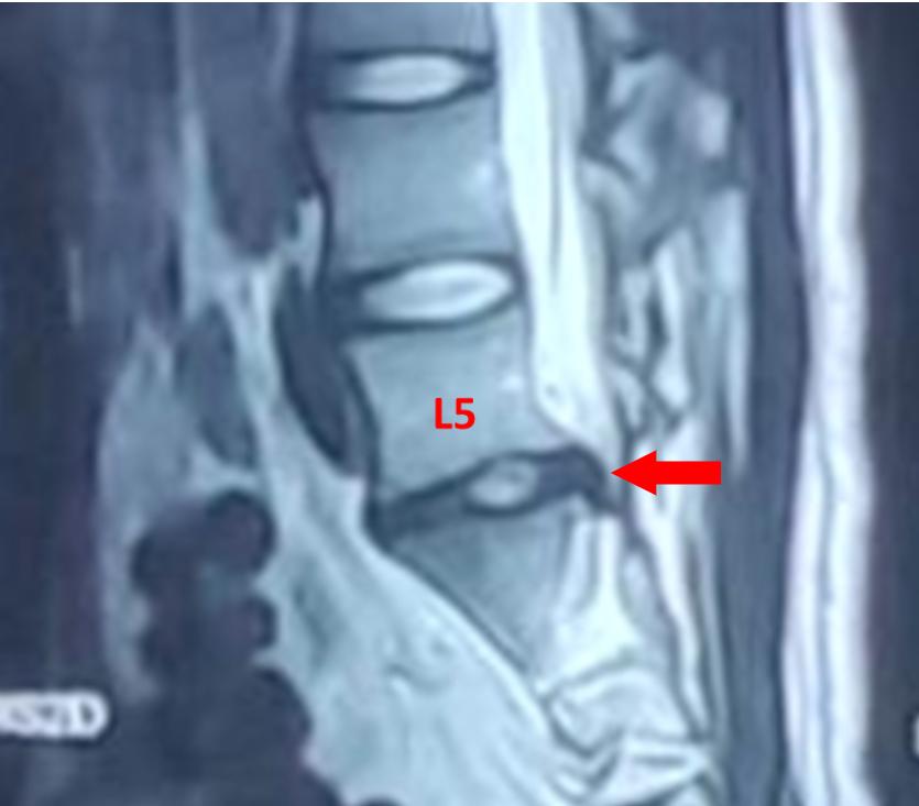 27岁摔成了腰椎间盘突出症,少年腰椎间盘突出怎么治疗