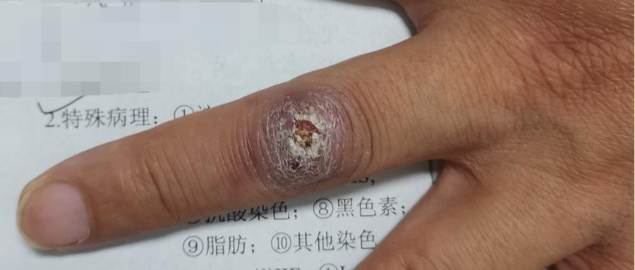 被鱼扎伤手指有个红点,被鱼扎伤手指肿了怎么办