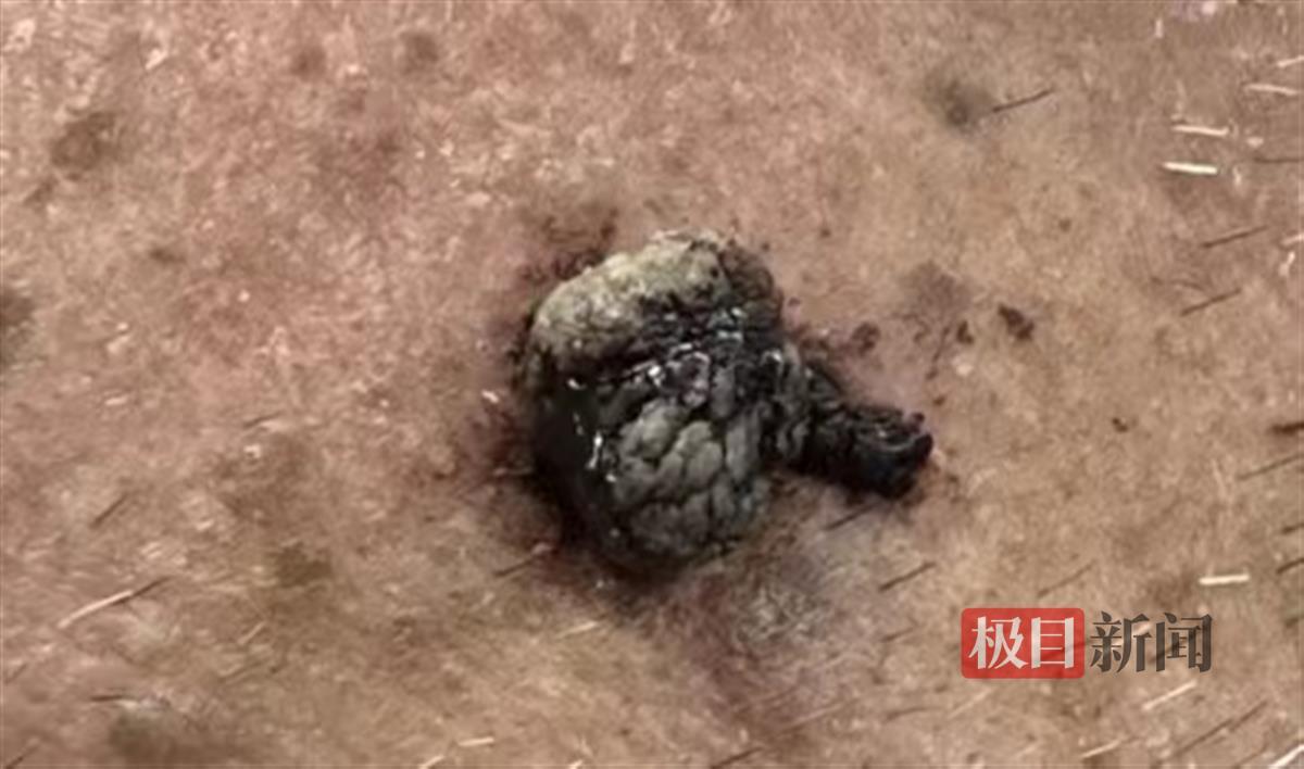 老人脸上无缘无故长了一个黑瘤,老人脸上长瘤子破了出血