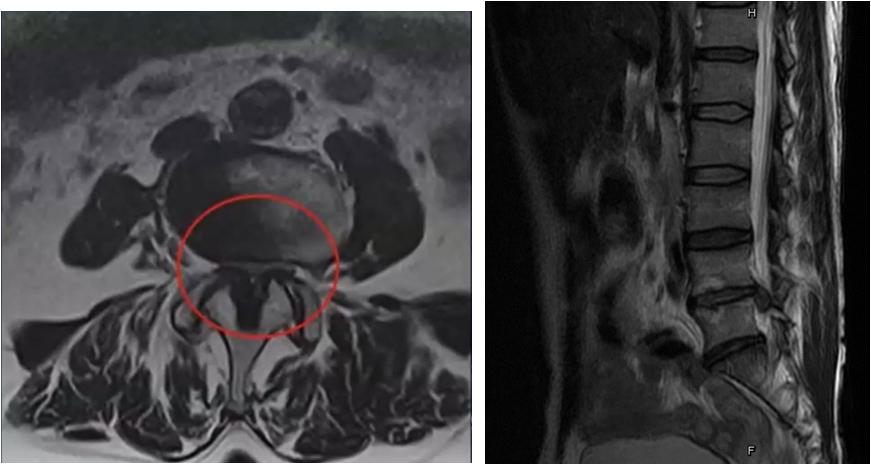 脊椎检查方法有几种,脊椎肿瘤做什么检查