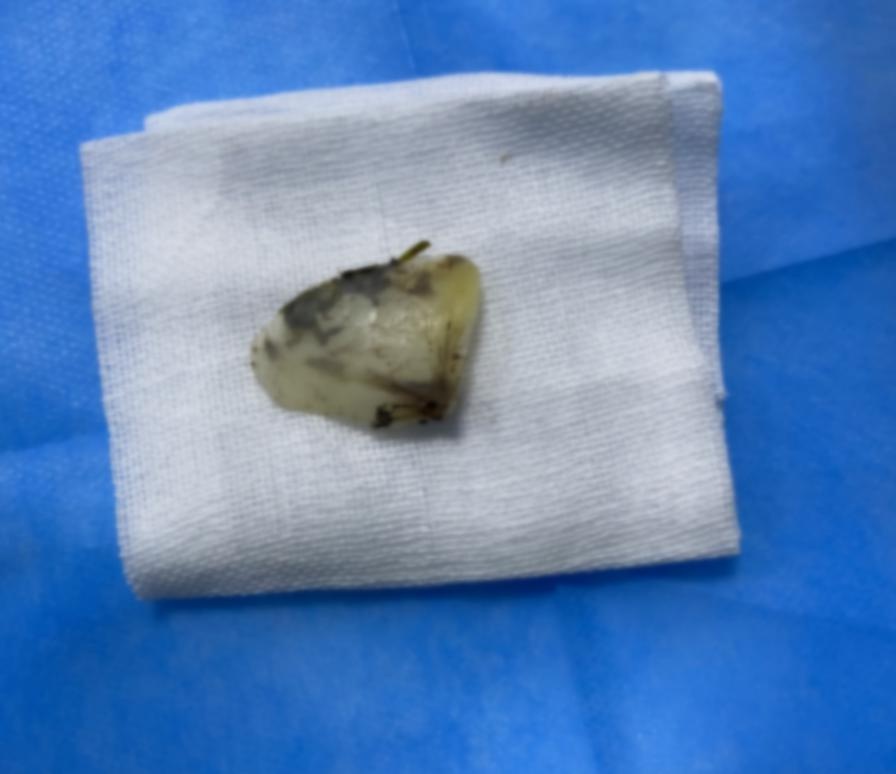 取出的骨片边缘锋利似刀片！女子摸黑吞食财鱼面被鱼鳃骨“割喉”