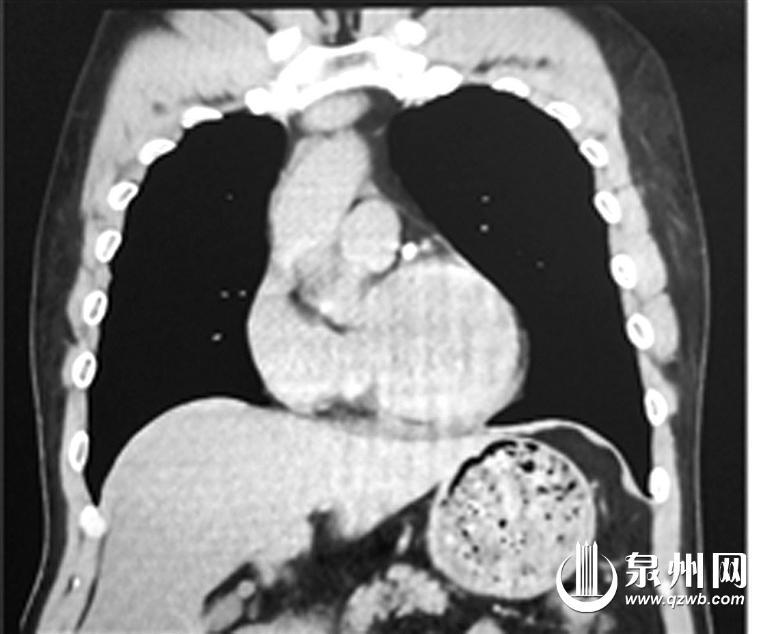 罕见镜面人手术反着来,医生手术切除罕见肿瘤