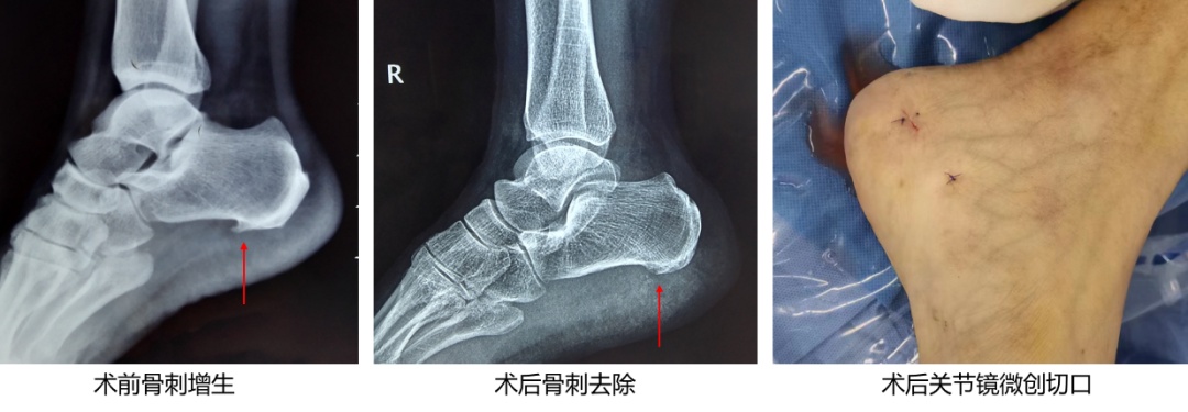 老人脚跟痛怎么治疗最好,后脚跟痛是怎么回事怎么样治疗