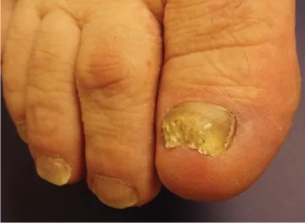 指甲有竖纹有月牙怎么回事,指甲月牙不是很白怎么回事