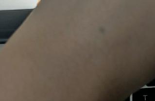 小孩把铅笔芯不小心捅进手皮里了,8岁孩子被铅笔戳到手怎么办