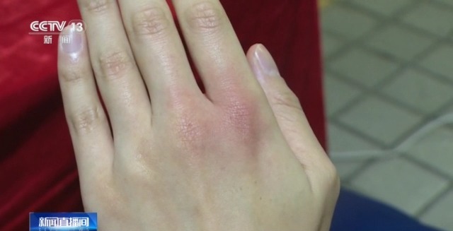 使用御寒神器小心低温烫伤,取暖不当小心低温烫伤