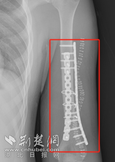高中生手臂掰断,高中生掰手腕掰断了